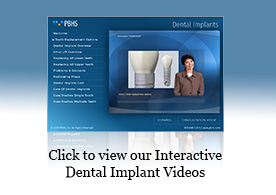 Apresentação de implantes dentários