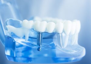 implantes dentales informáticos orlando fl