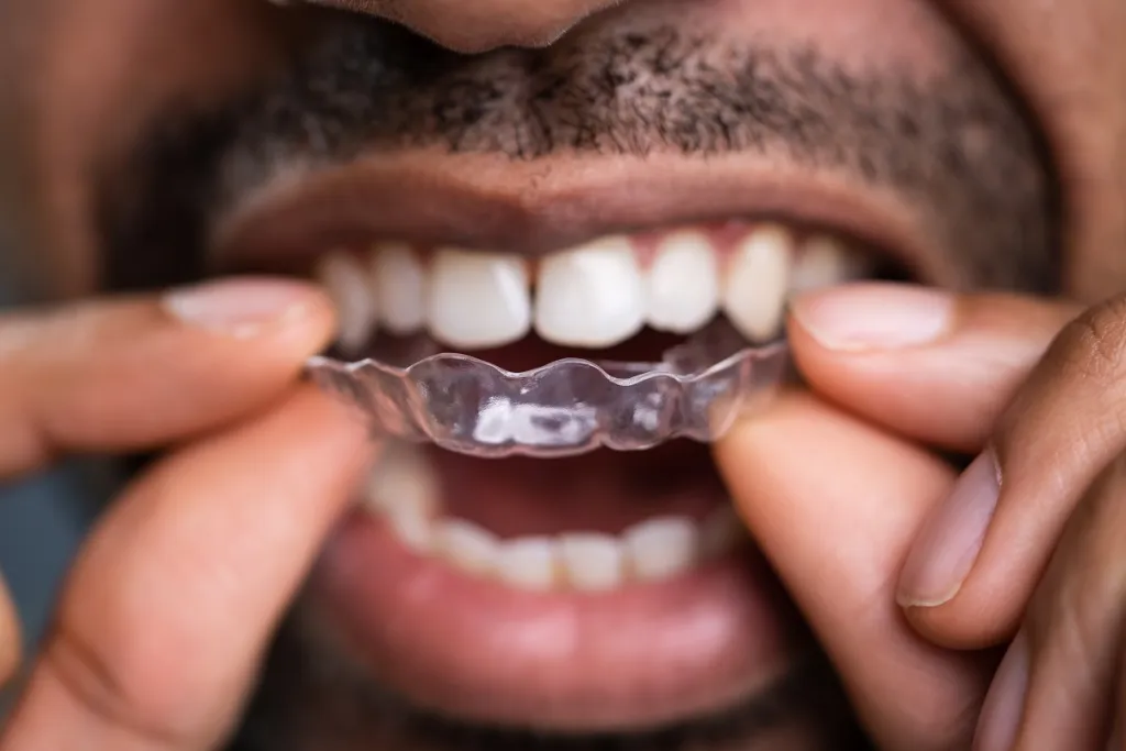 a man places a clear aligner in his mouth