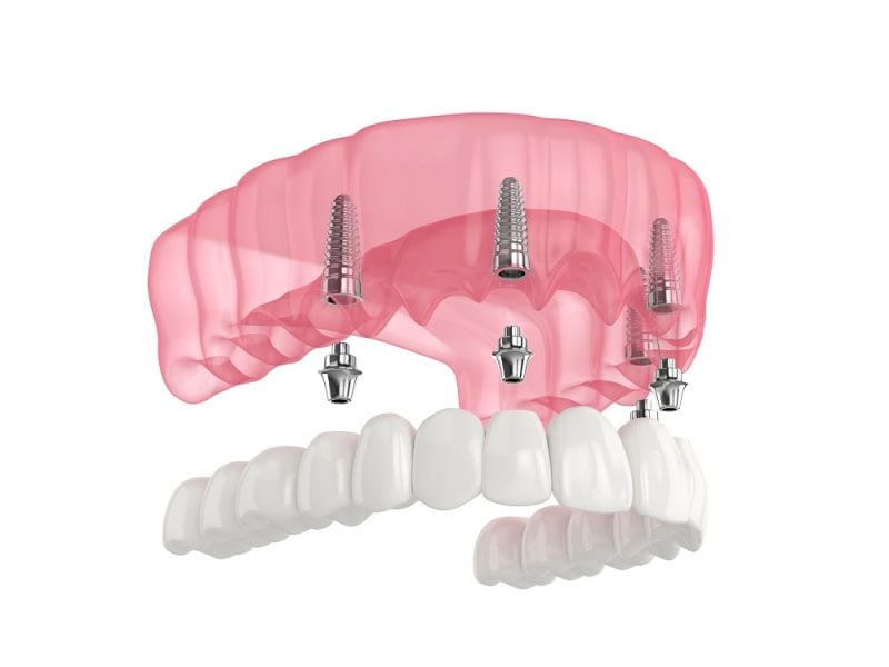 All-On-4 dental implant animation
