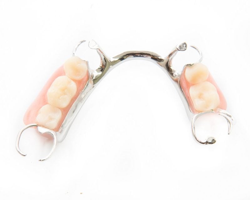 removable partial denture