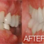 Real Invisalign patient from Orlando Dentistry