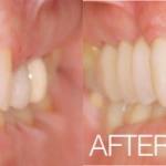 Real Invisalign patient from Orlando Dentistry
