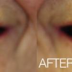Real Invisalign patient from Orlando Dentistry