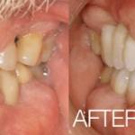 Real Invisalign patient from Orlando Dentistry