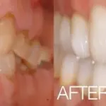 Real Invisalign patient from Orlando Dentistry